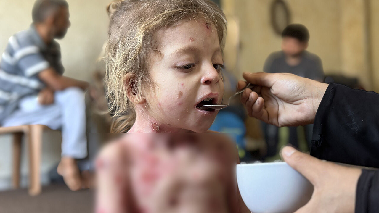 Gazze'de büyük dram! Kelebek hastası küçük kız tedavi olmayı bekliyor - 1. Resim