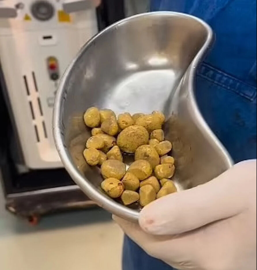 Günde 3 litre kola içiyordu! Mesanesinden çıkanlar doktorları bile hayrete düşürdü - 1. Resim