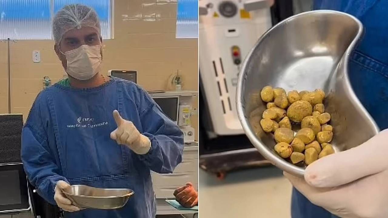Günde 3 litre kola içiyordu! Mesanesinden çıkanlar doktorları bile hayrete düşürdü