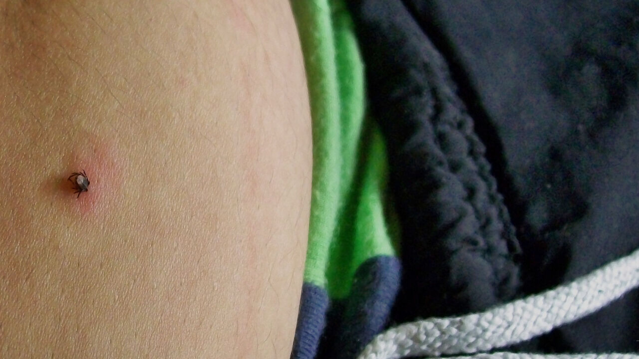 Kene ısırması belirtileri neler, kene öldürür mü, nasıl çıkarılır? Kırım Kongo Kanamalı Ateşi (KKKA) Kene ısırması belirtileri neler, kene öldürür mü, nasıl çıkarılır? Kırım Kongo Kanamalı Ateşi (KKKA) - 4. Resim