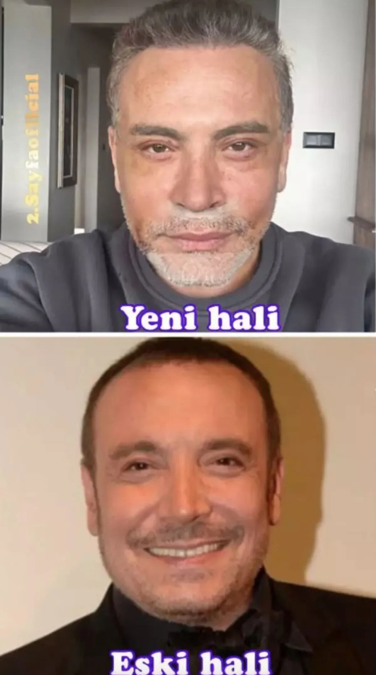 Yüz gerdirme operasyonu sonrası Cenk Eren’in son hali olay oldu: Eleştiri yağdı Yüz gerdirme operasyonu sonrası Cenk Eren’in son hali olay oldu: Eleştiri yağdı - 3. Resim