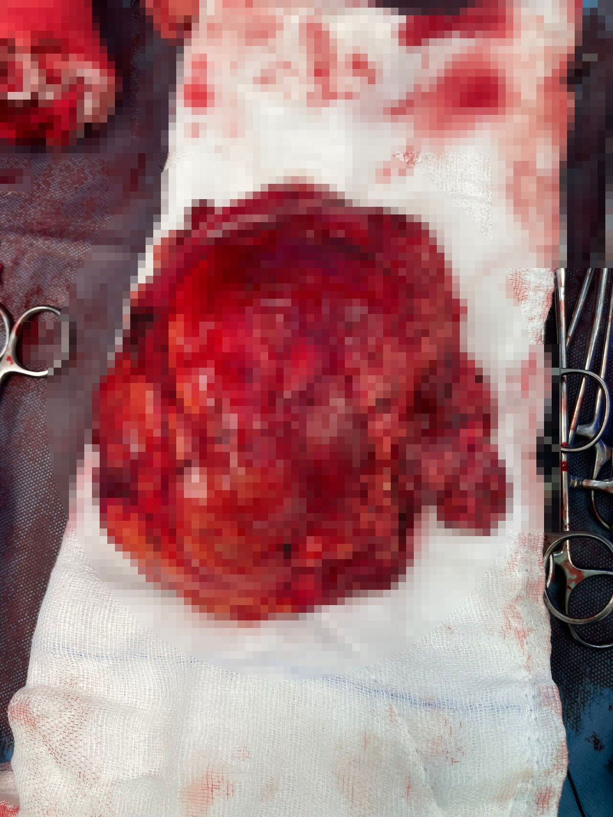 Uzmanlar “nadir görülür” dedi, kimse ameliyat etmek istemedi! Böbreğinden çıkan şoke etti - 2. Resim