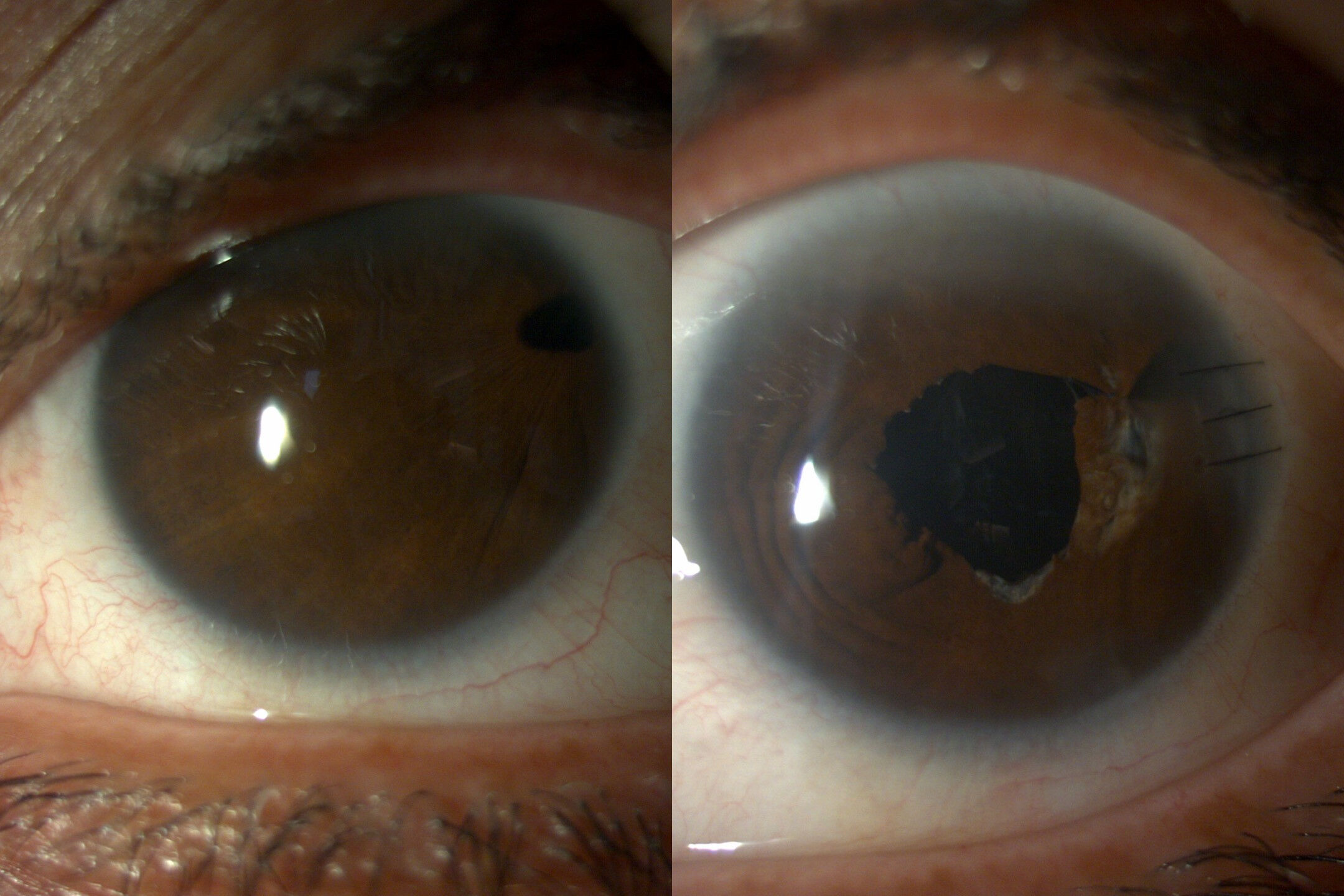 53 yıllık karanlık bitti! Riskli ameliyatla gözleri açıldı 53 yıllık karanlık bitti! Riskli ameliyatla gözleri açıldı - 1. Resim