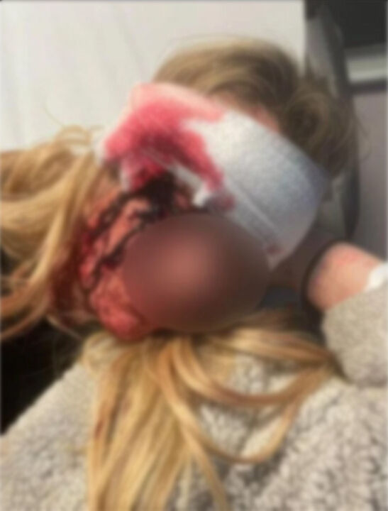 Vahşetin böylesi! Kız arkadaşının kaşını ısırarak koparttı: Sebebi ise kan dondurdu - 2. Resim