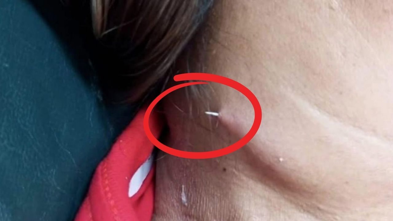 Doktorlar bile şaştı! Yuttuğu balık kılçığı boynunu delip geçti Doktorlar bile şaştı! Yuttuğu balık kılçığı boynunu delip geçti