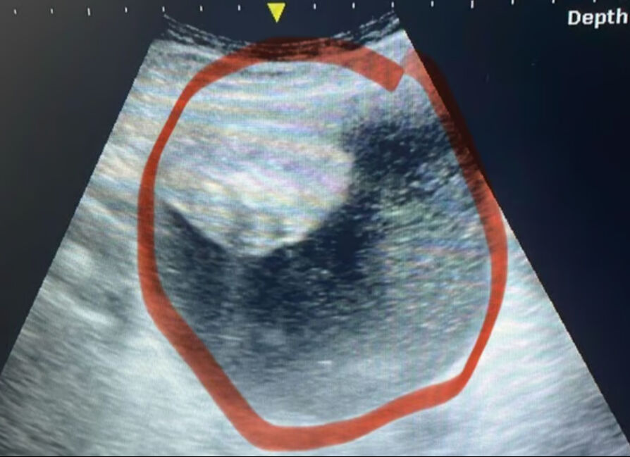 Karnındaki şişkinlik sebebiyle başvurmuştu! 3 günde 5 santimetre: Acı gerçek ortaya çıktı - 2. Resim