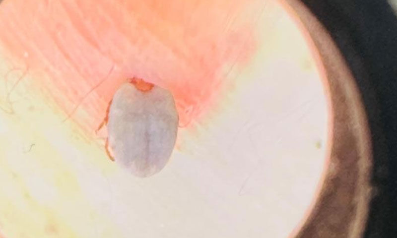 Halsizlik ve yorgunluk hastaneye koştu! Meğer kene göbeğine yapışmış - 2. Resim