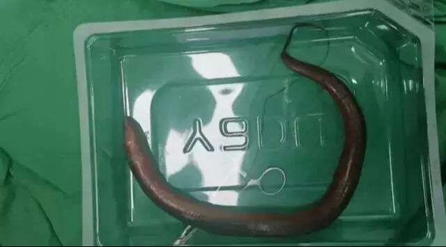 Karın ağrısı şikayetiyle başvurmuştu! Karnından çıkan doktorları hayrete düşürdü: Adeta yüzüyor - 1. Resim