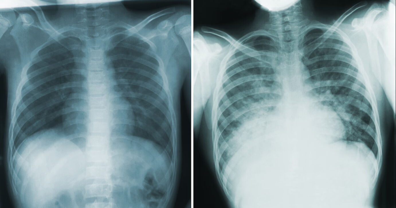 ABD’de ölümcül akciğer vebası geri döndü! Yıllar sonra ilk ölüm - 1. Resim