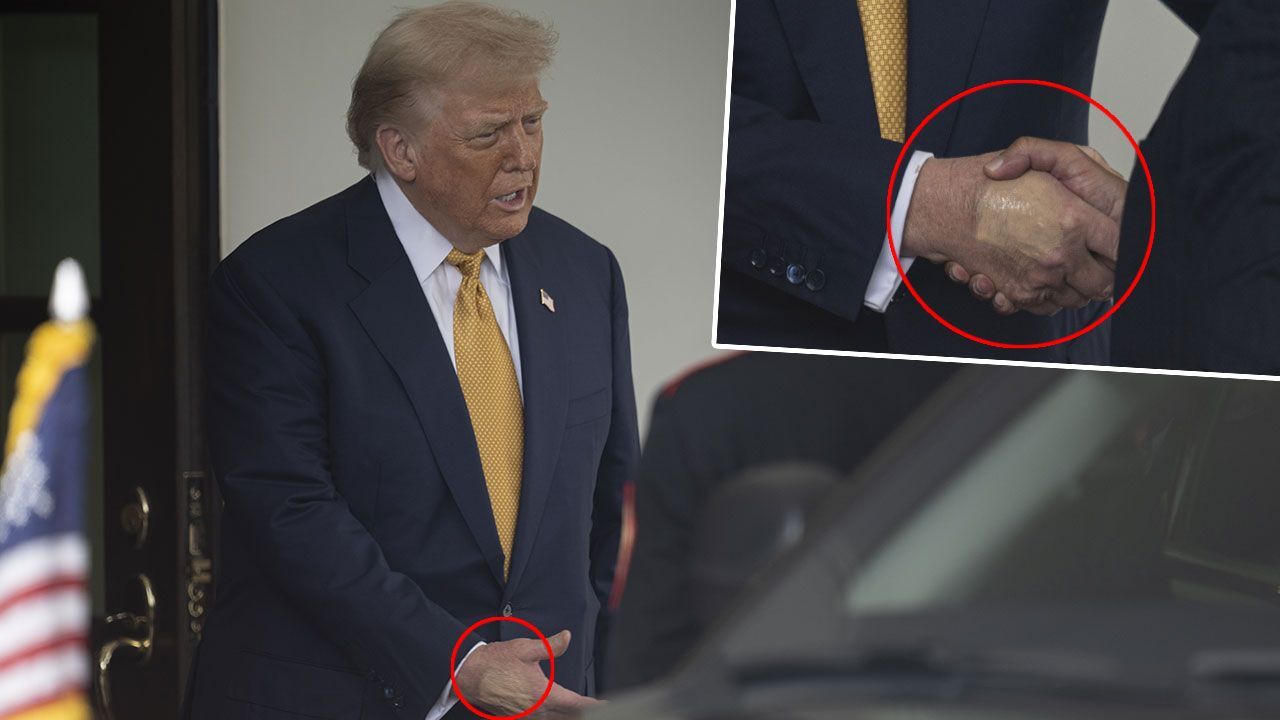 Trump’ın makyajla kapatılan elindeki morluk dikkat çekti! Beyaz Saray&#039;dan açıklama geldi