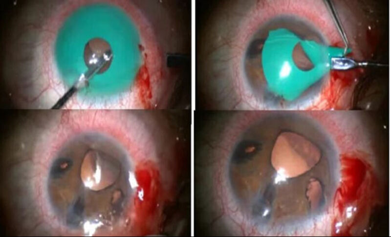 Renk ararken dünyanız kararmasın! Göz rengi değiştirme ameliyatı kör bırakabilir - 1. Resim