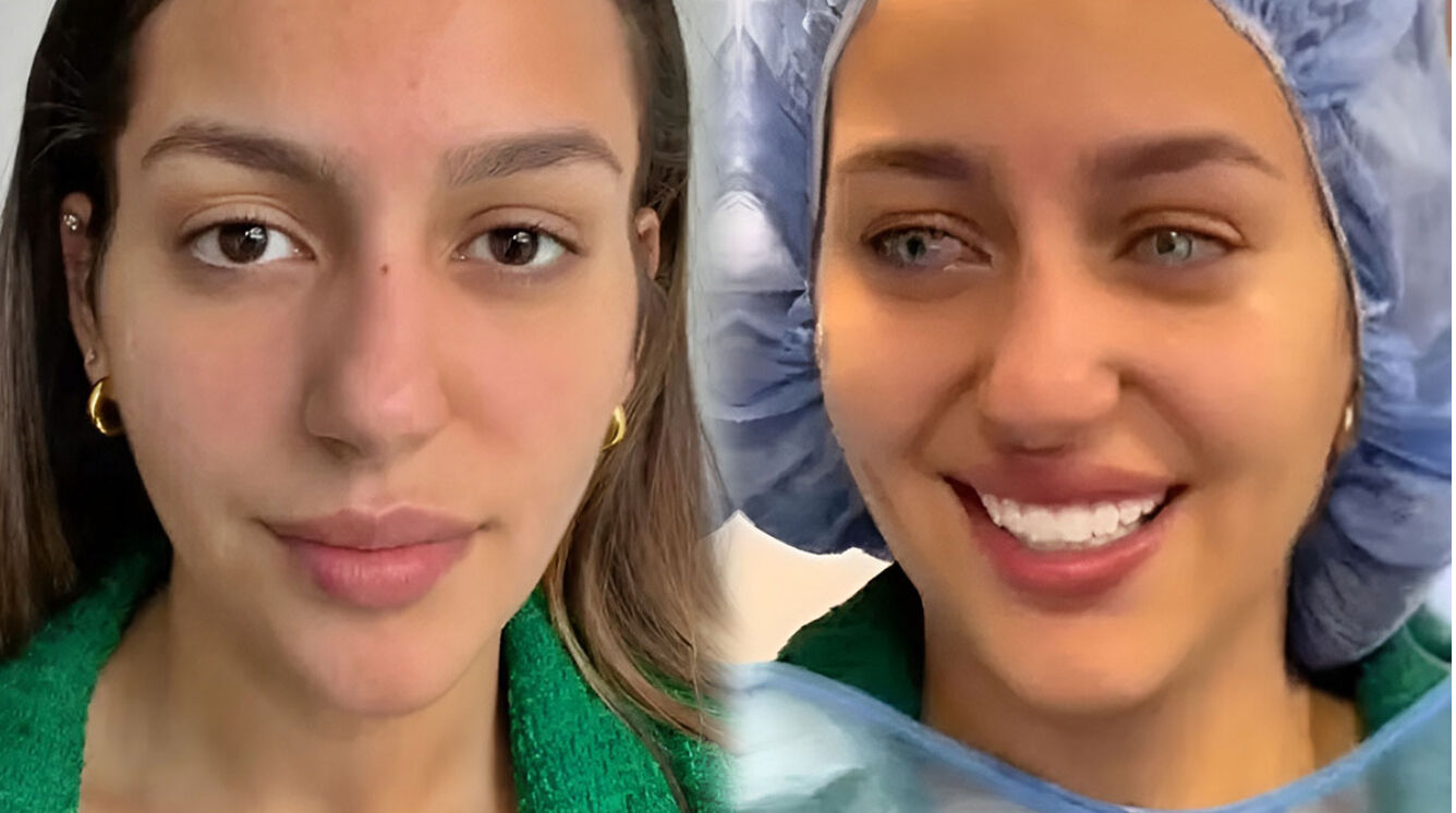 Renk ararken dünyanız kararmasın! Göz rengi değiştirme ameliyatı kör bırakabilir - 3. Resim