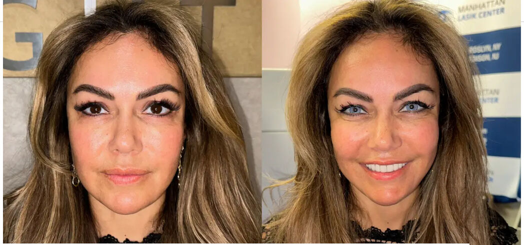 Renk ararken dünyanız kararmasın! Göz rengi değiştirme ameliyatı kör bırakabilir - 6. Resim