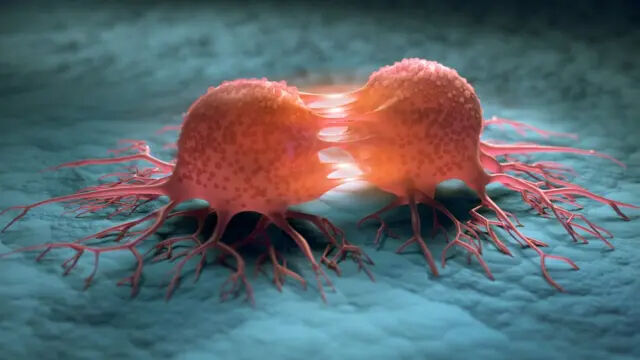 Sarkom nedir, yumuşak doku kanseri neden olur? Sarkom hastalığı belirtileri - 2. Resim