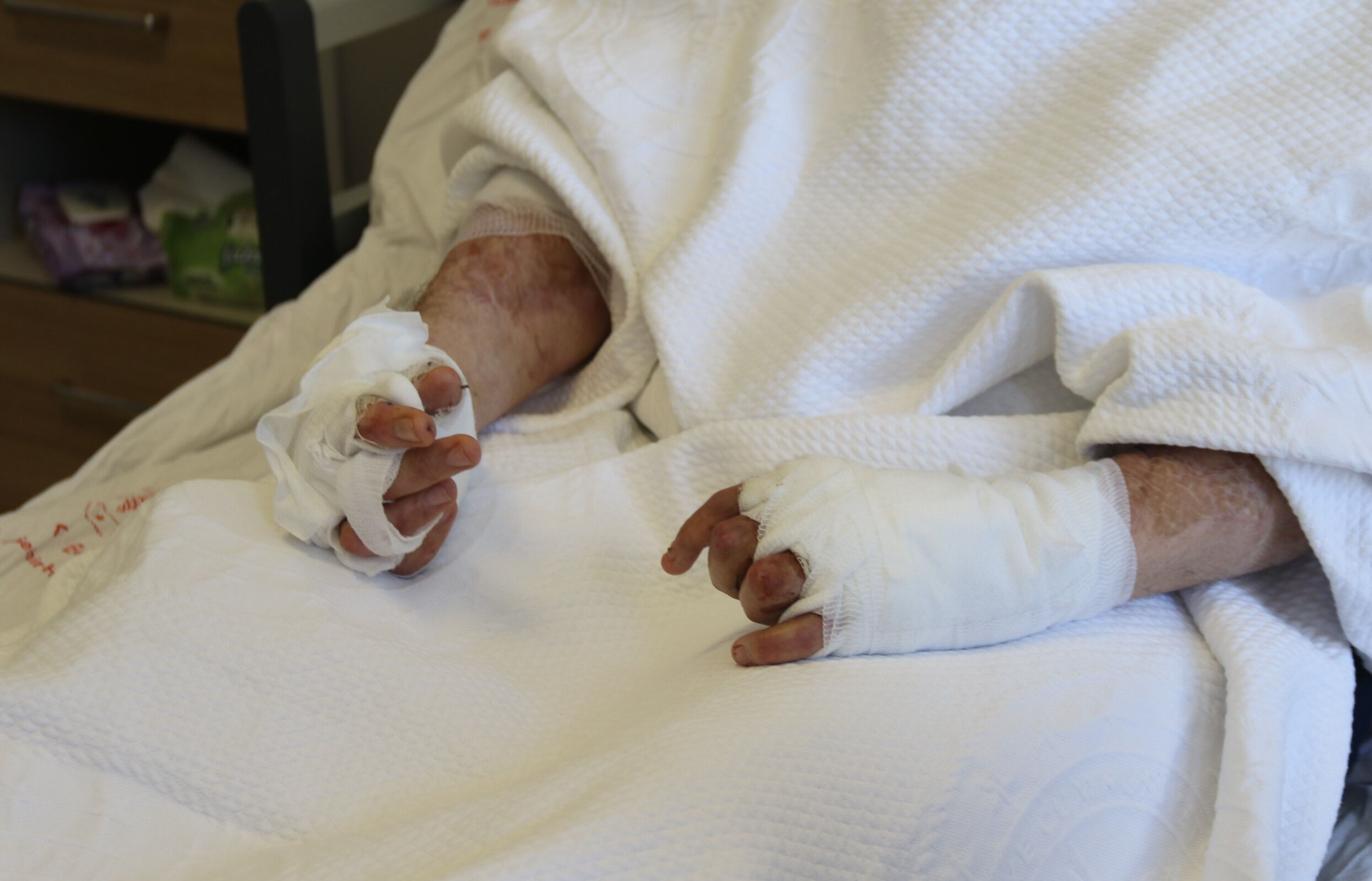 6 bin voltluk elektrik çarptı, ölmedi! Azerbaycan'dan Eskişehir'e getirilen mühendisin elleri hareket etmeye başladı - 3. Resim