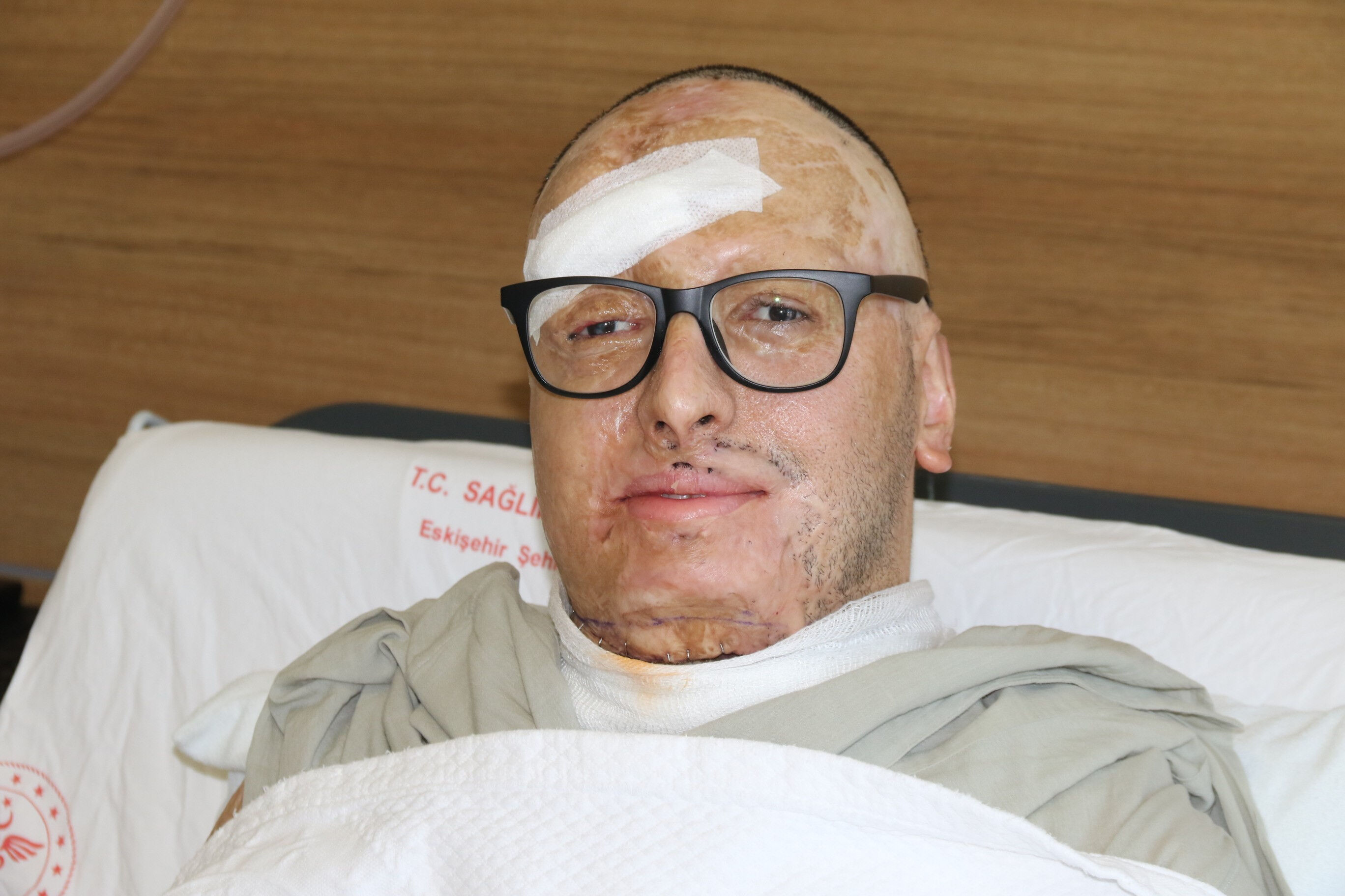 6 bin voltluk elektrik çarptı, ölmedi! Azerbaycan'dan Eskişehir'e getirilen mühendisin elleri hareket etmeye başladı - 1. Resim