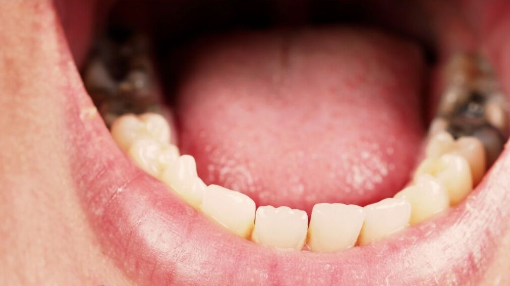 Diş çürüğü ölüme götürebilir, geri dönülmez hasarlar verebilir! Uzman kardiyologdan korkutan uyarı - 1. Resim