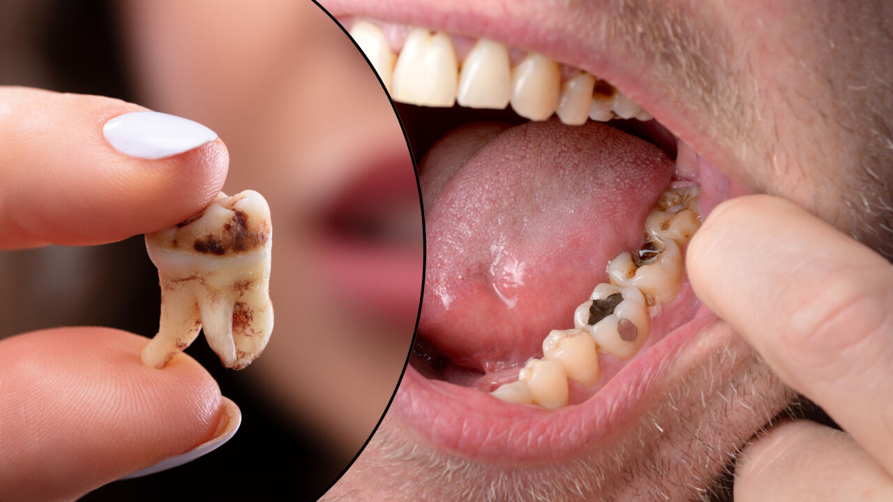 Diş çürüğü ölüme götürebilir, geri dönülmez hasarlar verebilir! Uzman kardiyologdan korkutan uyarı - 4. Resim