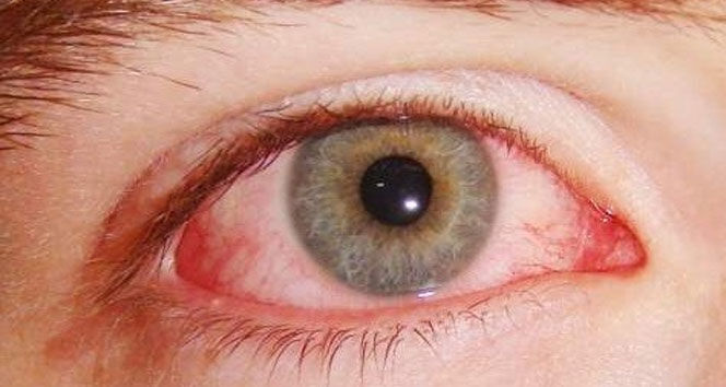 Seğirmeyi hafife almayın! Gözleriniz vücudunuzun alarmını veriyor olabilir... - 3. Resim