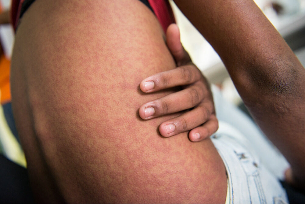 Chikungunya virus nedir, bulaşıcı mı, ölümcül mü? Dünya Sağlık Örgütü uyardı! Chikungunya virus nedir, bulaşıcı mı, ölümcül mü? Dünya Sağlık Örgütü uyardı! - 1. Resim