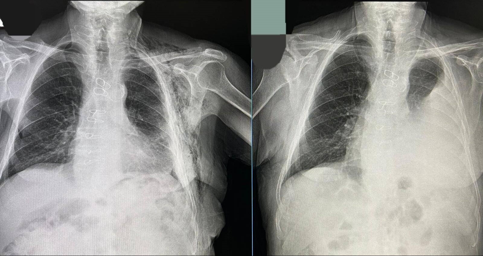 Rutin kontrolde ortaya çıktı! ByPass sonrası gizli tehlike neredeyse canına mal oluyordu - 1. Resim