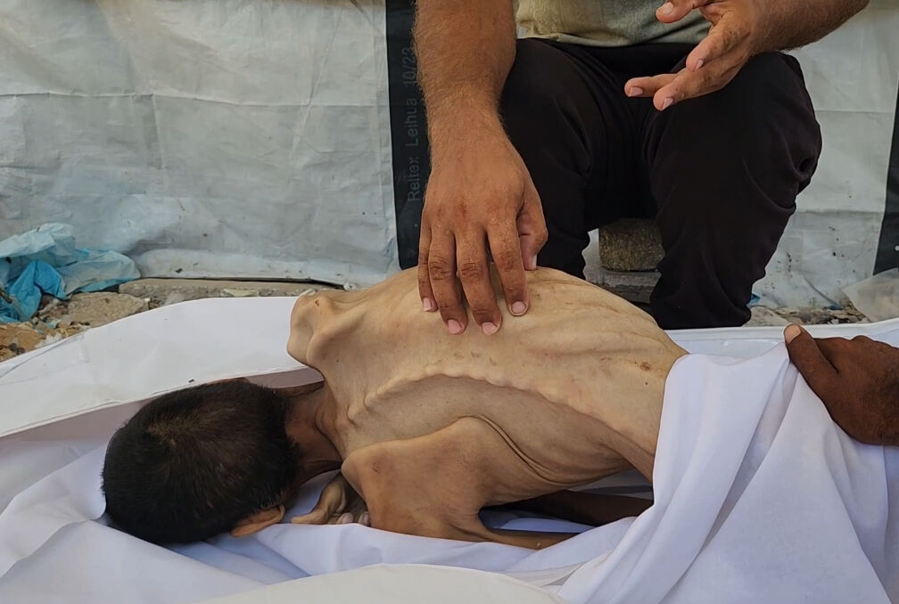 Bu acıya yürek dayanmaz... Görenlerin içini sızlattı! 27 yaşında açlıktan 15 kiloya düştü Görenlerin içini sızlattı! 27 yaşında 15 kiloya düştü - 2. Resim