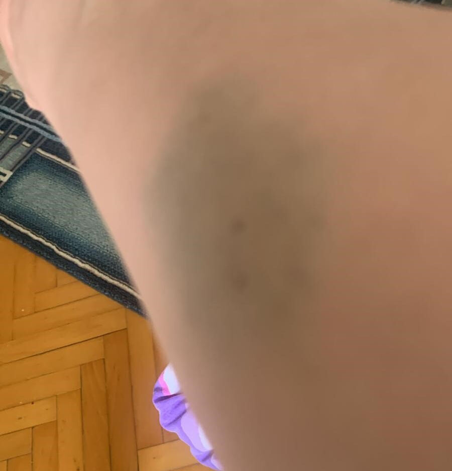 İki ülkede doktor doktor gezdi, çare bulamadı: Dilinin yapısı bile değişti! Nedeni pes dedirtti İki ülkede doktor doktor gezdi, çare bulamadı: Dilinin yapısı bile değişti! Nedeni pes dedirtti - 1. Resim