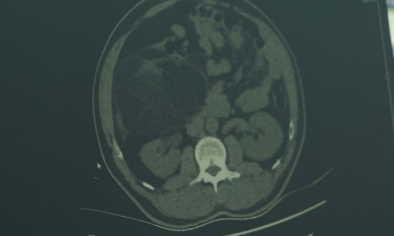 Karın ağrısıyla gitti, karnından dev kitle çıktı! “Ben de beklemiyordum” Karın ağrısıyla gitti, karnından dev kitle çıktı! “Ben de beklemiyordum” - 1. Resim