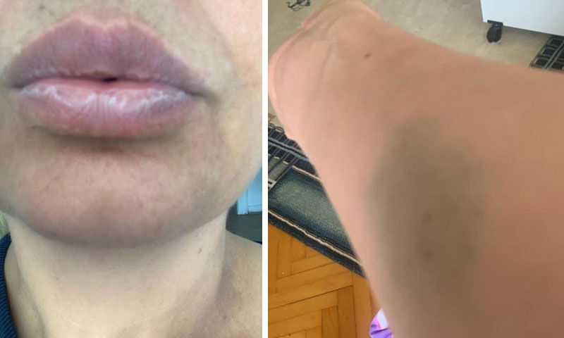 Nefes darlığı ve uyuşma şikayetleriyle başvurdu! Almanya’da teşhis konulamadı, Türkiye’de gerçek ortaya çıktı Nefes darlığı ve uyuşma şikayetleriyle başvurdu! Almanya’da teşhis konulamadı, Türkiye’de gerçek ortaya çıktı - 1. Resim