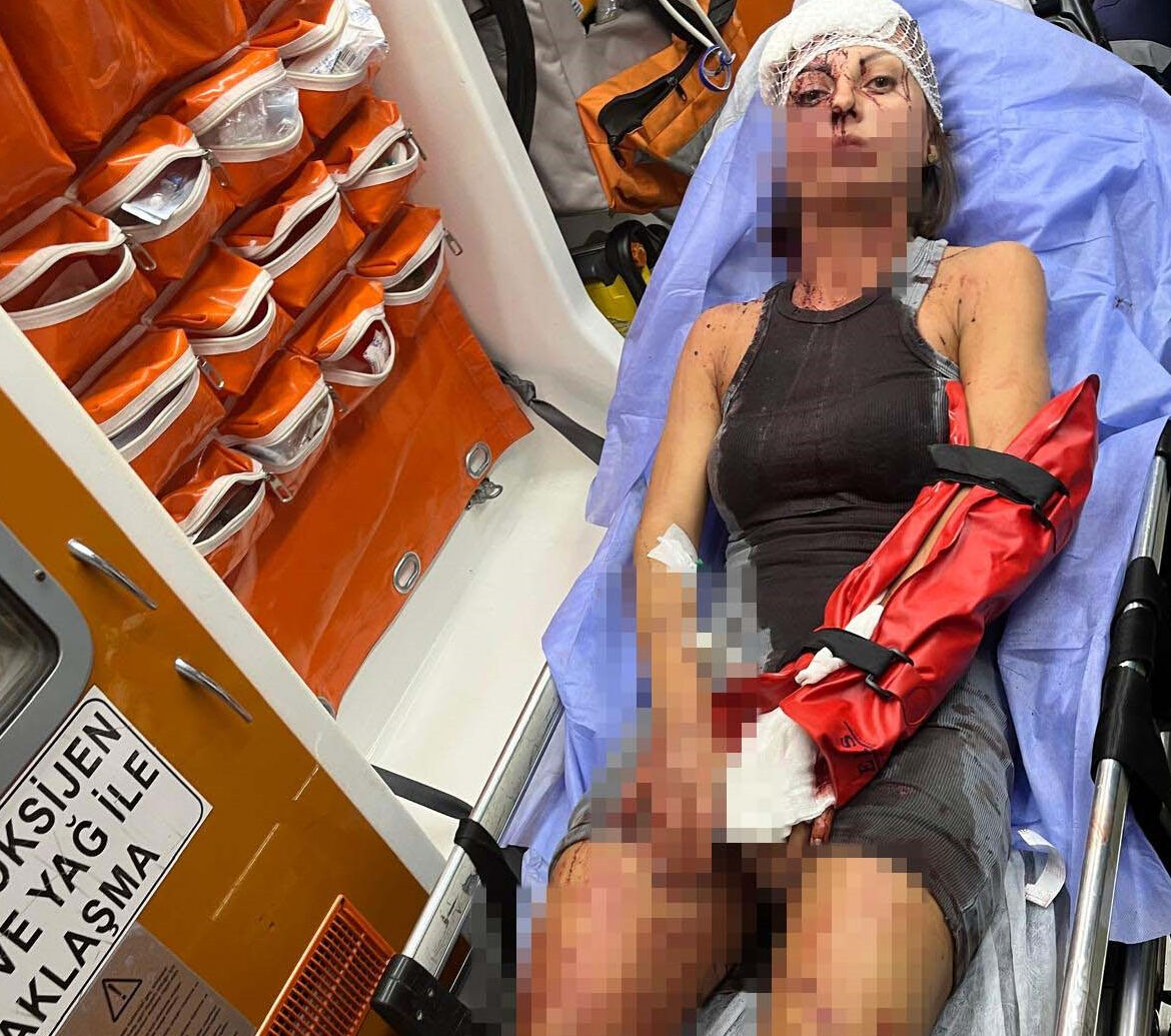 Uzaklaştırma kararı aldırdığı eşi, kırılmadık kemiğini bırakmadı! Eli paramparça, kafatasında zımbalar... - 1. Resim