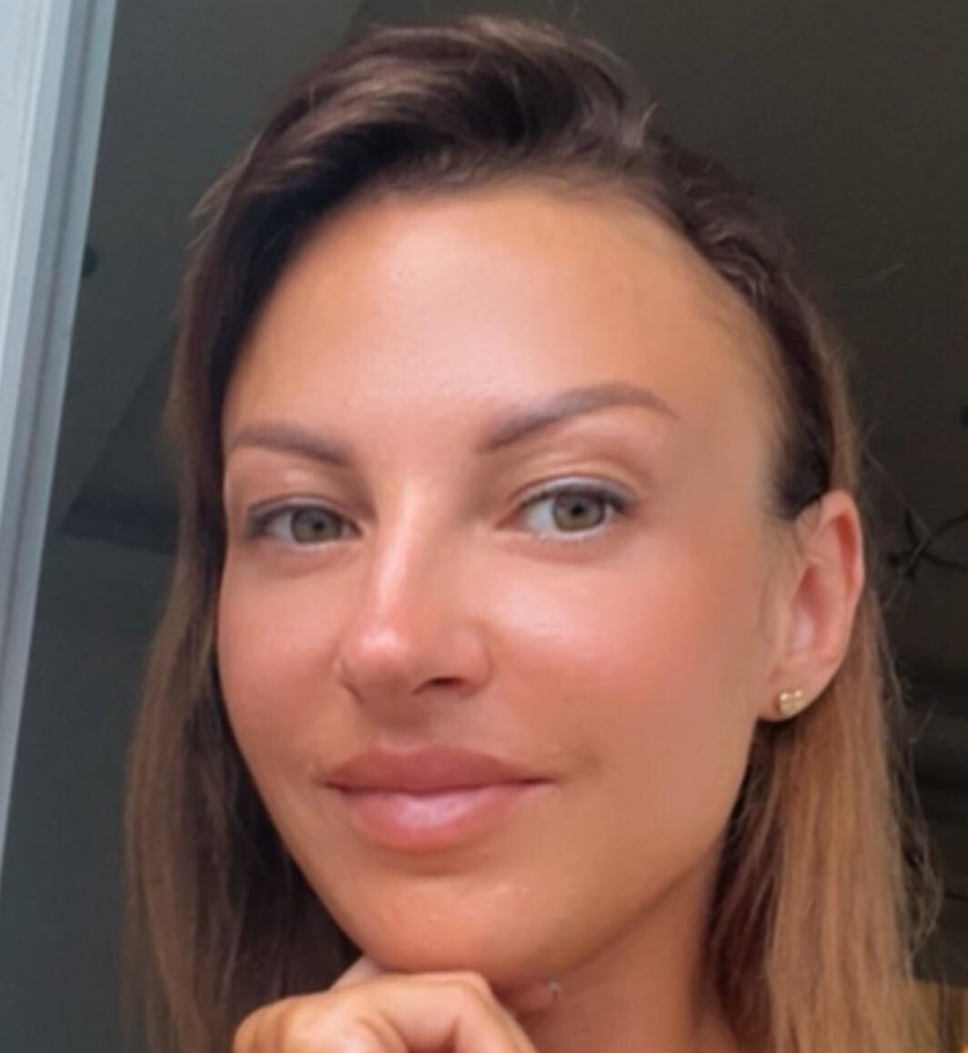 Uzaklaştırma kararı aldırdığı eşi, kırılmadık kemiğini bırakmadı! Eli paramparça, kafatasında zımbalar... - 2. Resim