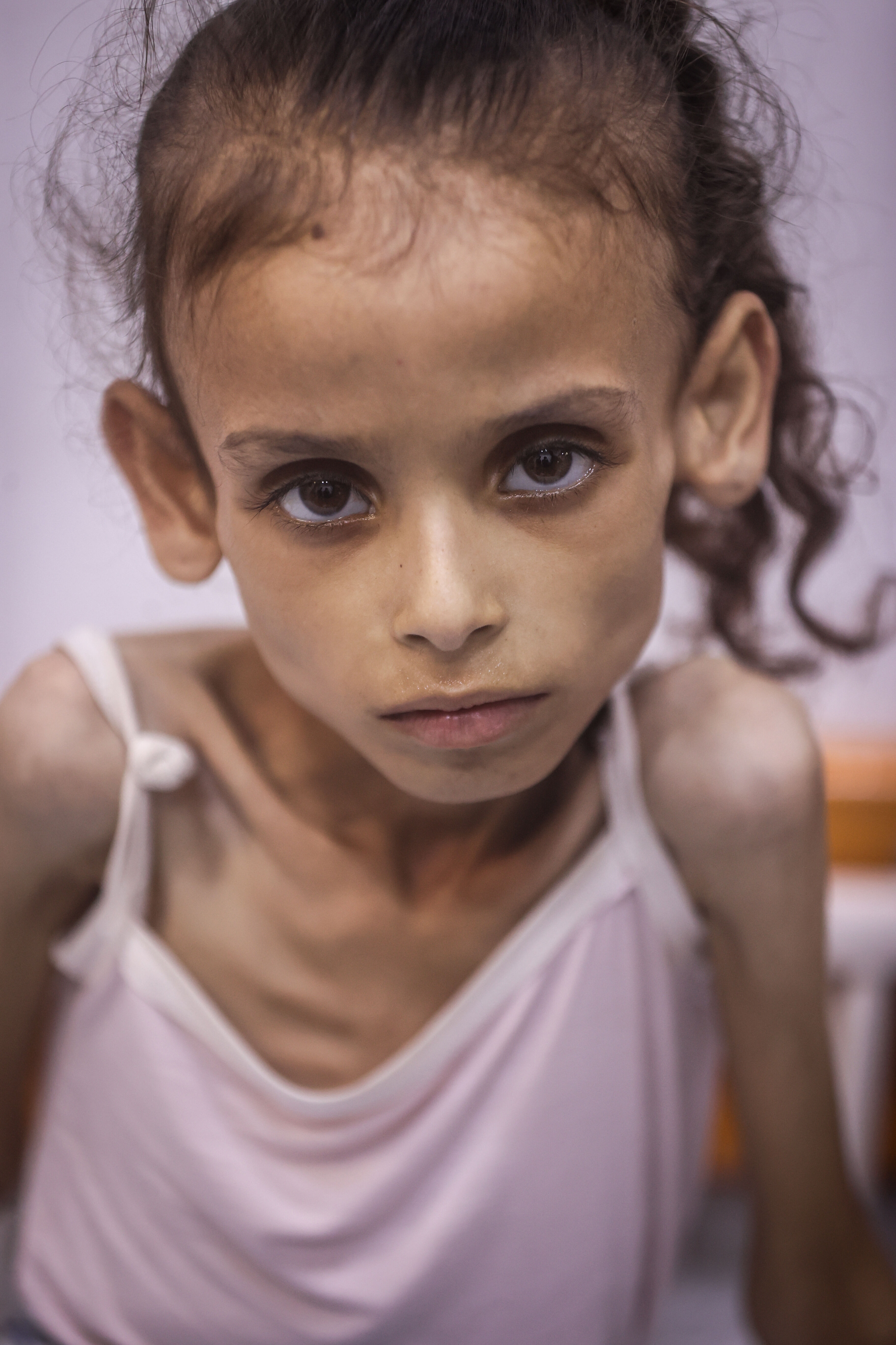 25 kilodan 10 kiloya düştü... Küçük Meryem, dünyanın gözleri önünde açlıktan eriyor 25 kilodan 10 kiloya düştü... Küçük Meryem, dünyanın gözleri önünde açlıktan eriyor - 2. Resim