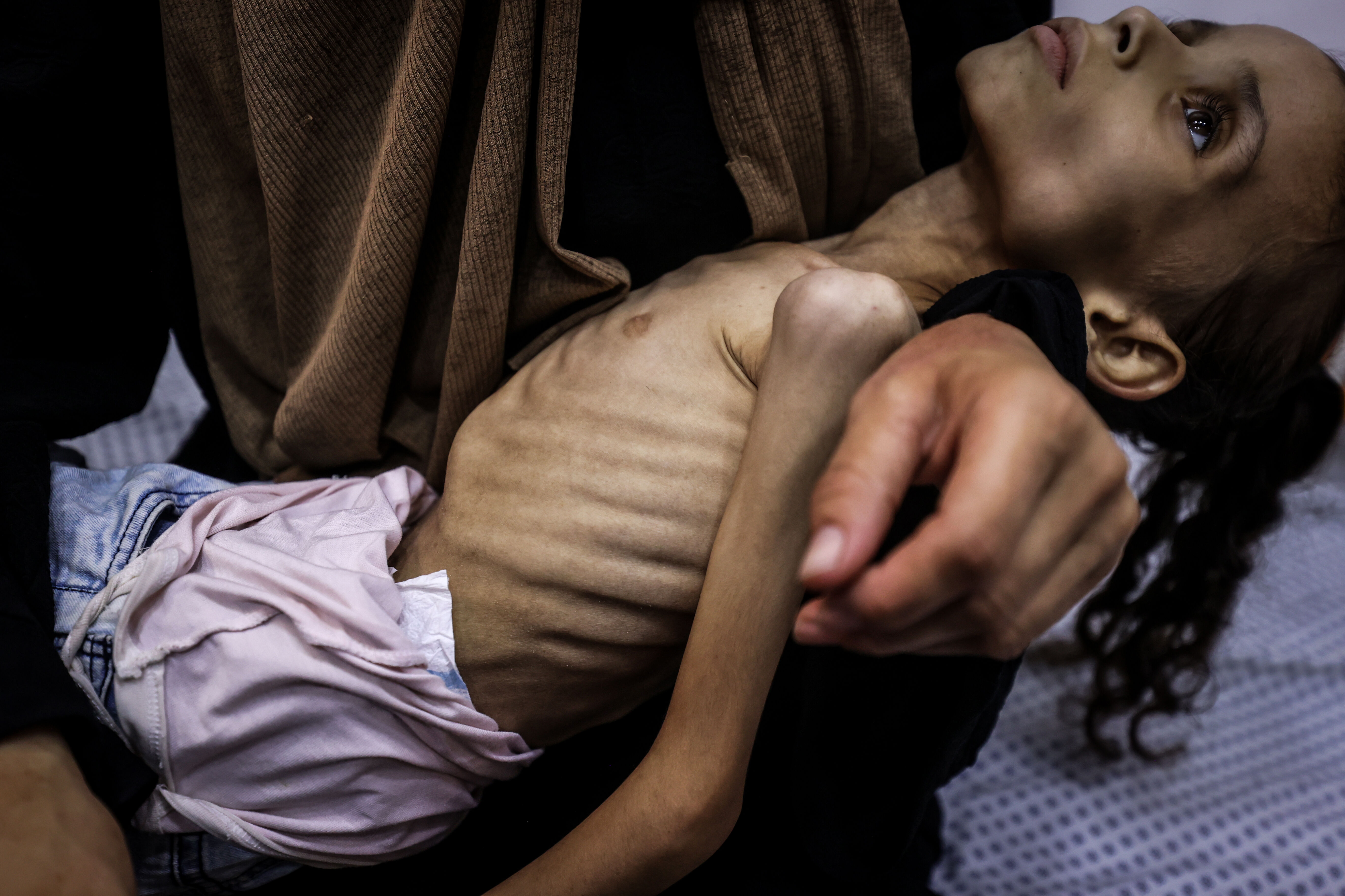 25 kilodan 10 kiloya düştü... Küçük Meryem, dünyanın gözleri önünde açlıktan eriyor 25 kilodan 10 kiloya düştü... Küçük Meryem, dünyanın gözleri önünde açlıktan eriyor - 3. Resim