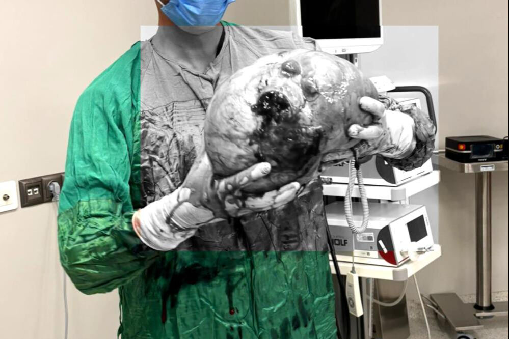 30 santimetre çapında, 4 kilo ağırlığında! Yaşlı kadın bir saatte kurtuldu 30 santimetre çapında, 4 kilo ağırlığında! Yaşlı kadın bir saatte kurtuldu - 1. Resim