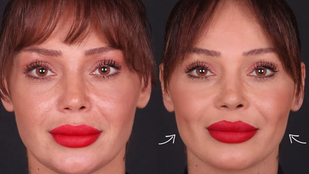 Estetik ameliyat akımlarında son nokta! Yapay gamze çılgınlığı - 1. Resim