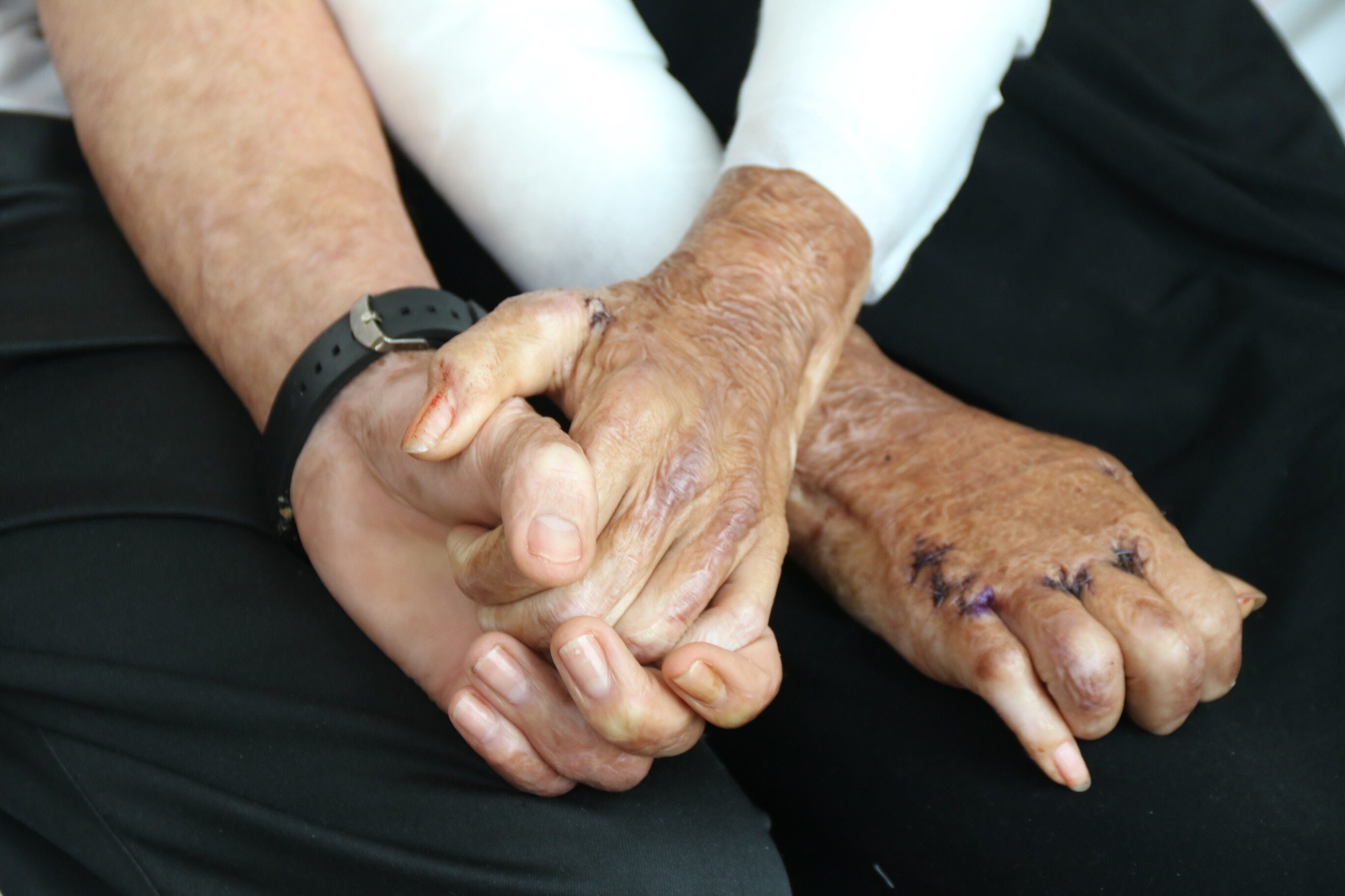 Düğüne 3 gün kala dehşeti yaşadılar! Patlamada kapanan elleri 3 yıl sonra yeniden kavuştu! - 4. Resim