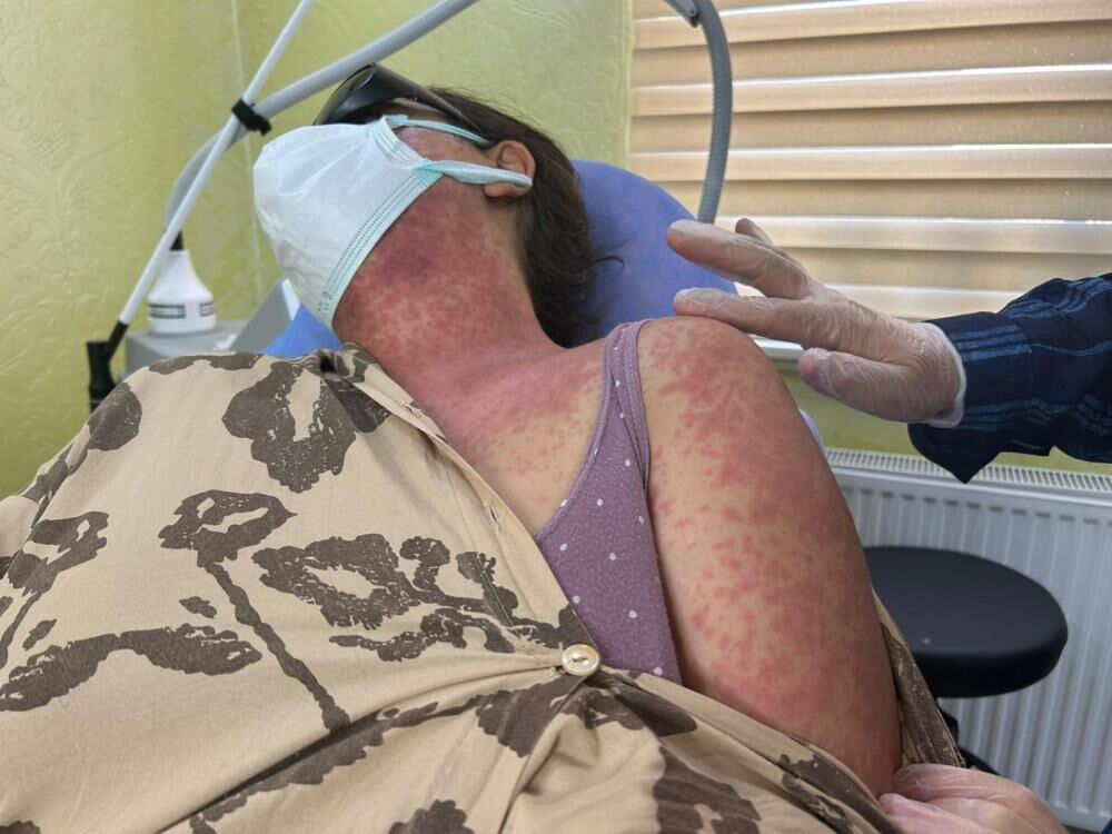 Cilt beyazlatma kremi kabusa dönüştü! 4 kişi hastanelik oldu - 3. Resim