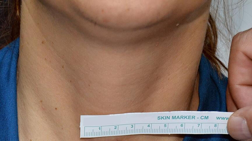 Boynunuzda şişlik varsa dikkat! O belirtiyi hafife almayın ve doktora koşun... - 1. Resim