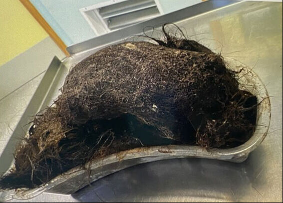 Karın ağrısı şikayetiyle gitmişti! Midesinden çıkanlar doktorları bile hayrete düşürdü: Gider deliği gibi... - 2. Resim