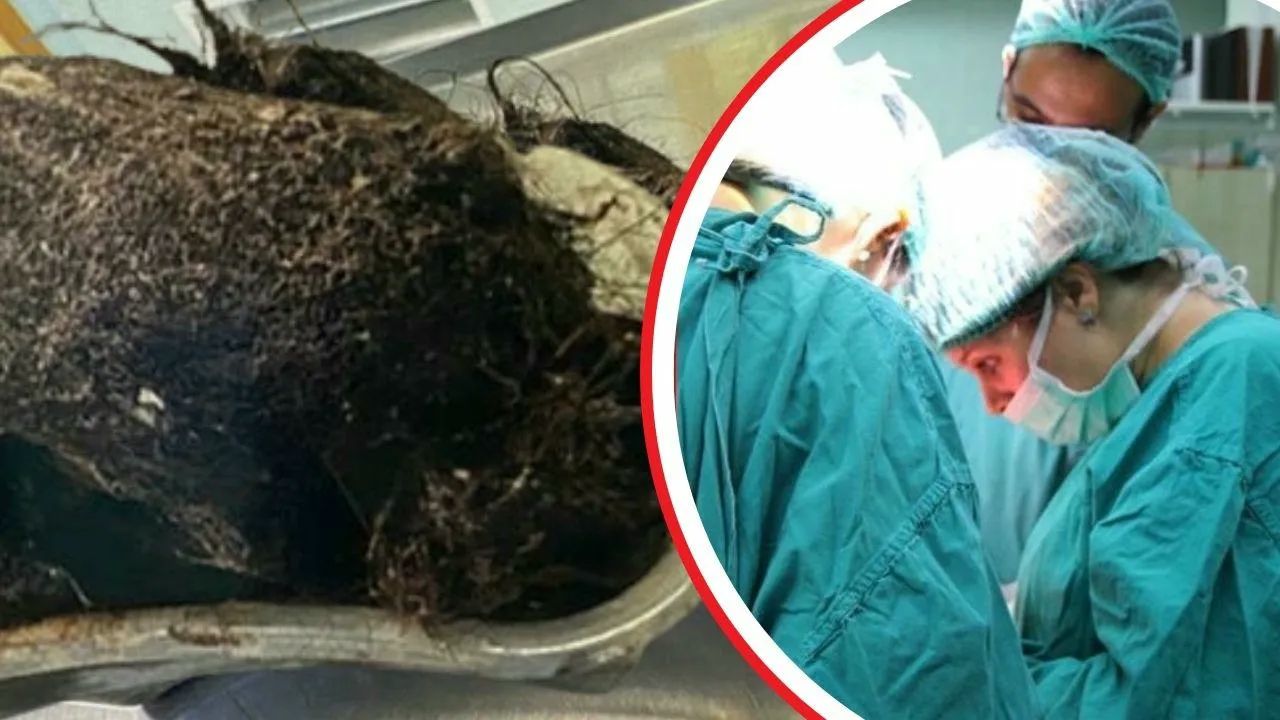Karın ağrısı şikayetiyle gitmişti! Midesinden çıkanlar doktorları bile hayrete düşürdü: Gider deliği gibi... Karın ağrısı şikayetiyle gitmişti! Midesinden çıkanlar doktorları bile hayrete düşürdü: Gider deliği gibi...