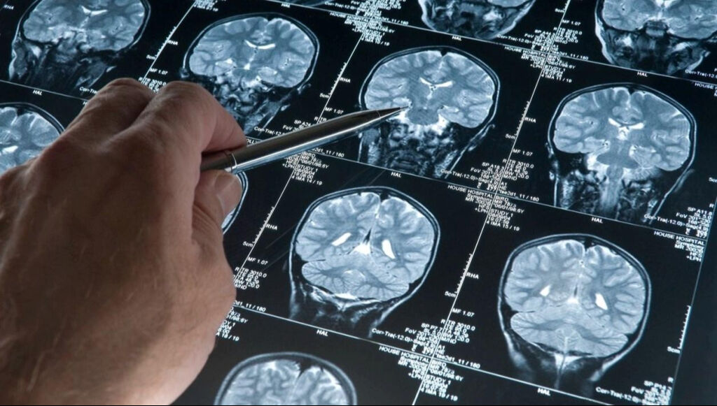 Alzheimer'a karşı doğal koruma kalkanı bulundu!