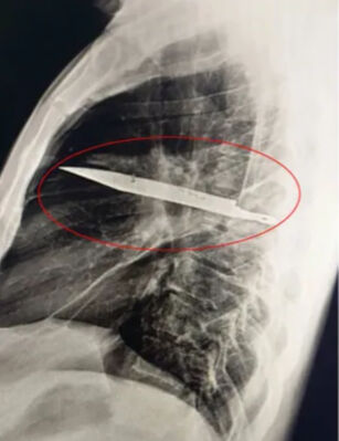 Göğüs ağrısı şikayetiyle gitmişti! Gerçek hastanede ortaya çıktı: Meğer 8 yıldır... - 3. Resim