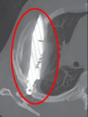 Göğüs ağrısı şikayetiyle gitmişti! Gerçek hastanede ortaya çıktı: Meğer 8 yıldır... - 1. Resim