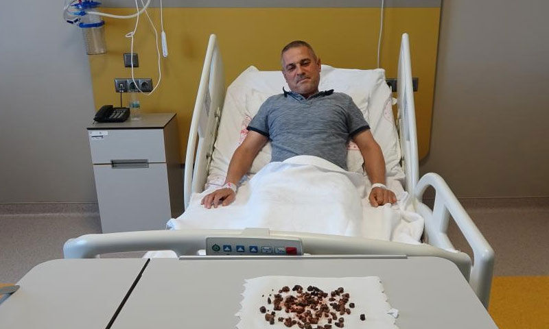 Şiddetli ağrıyla gitti, doktorlar gözlerine inanamadı: Tam 100 tane çıktı! - 1. Resim