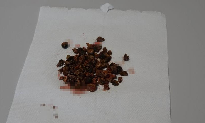 Şiddetli ağrıyla gitti, doktorlar gözlerine inanamadı: Tam 100 tane çıktı! - 3. Resim