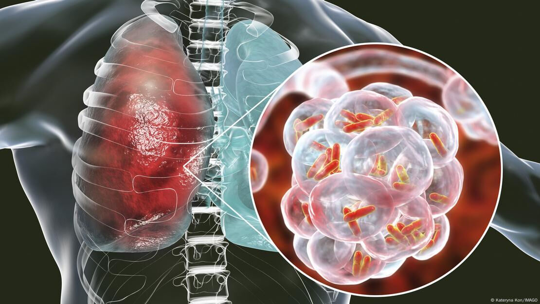 Hava solumak bile tehlikeli! 4 ölü, 99 vaka: Panik büyüyor! Ölümcül salgın ülkeyi esir aldı - 1. Resim