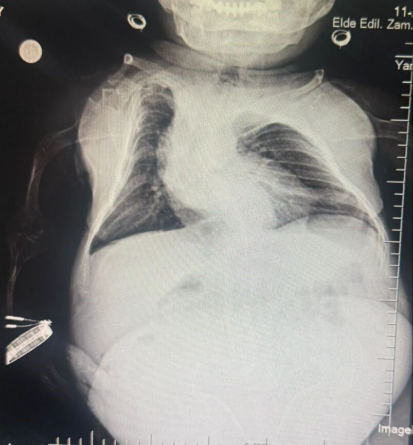 Karın ağrısı sandı, 3 kilogramlık kist çıktı! Akondroplazi hastası kadın sağlığına kavuştu - 3. Resim