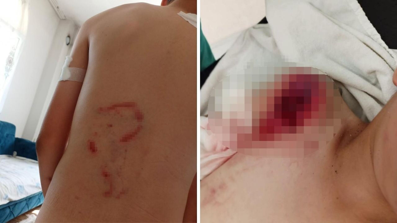 Köpek kolunu parçalamıştı! Küçük çocuğun sağ kolu felç kaldı... Aile adalet arıyor - 1. Resim