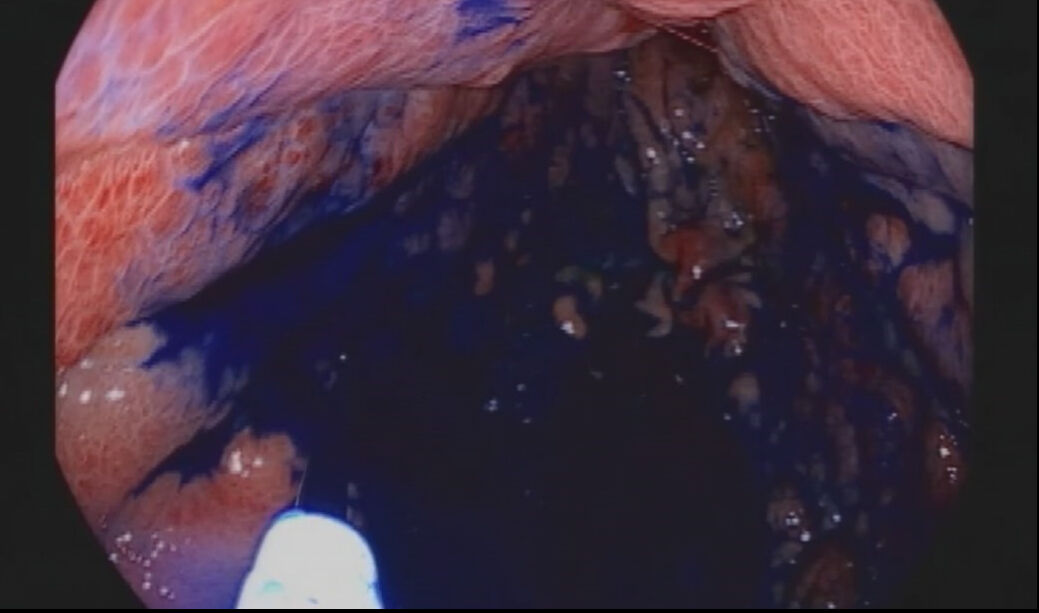 Boyama yöntemi ile mide ve bağırsak kanserinde erken teşhis... - 2. Resim
