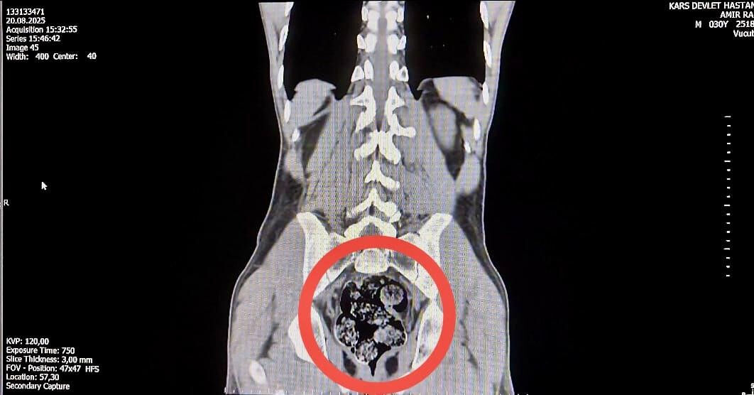 Otobüste yakalandılar, hastanede şoke ettiler! Makatından 7 parça uyuşturucu çıktı - 1. Resim